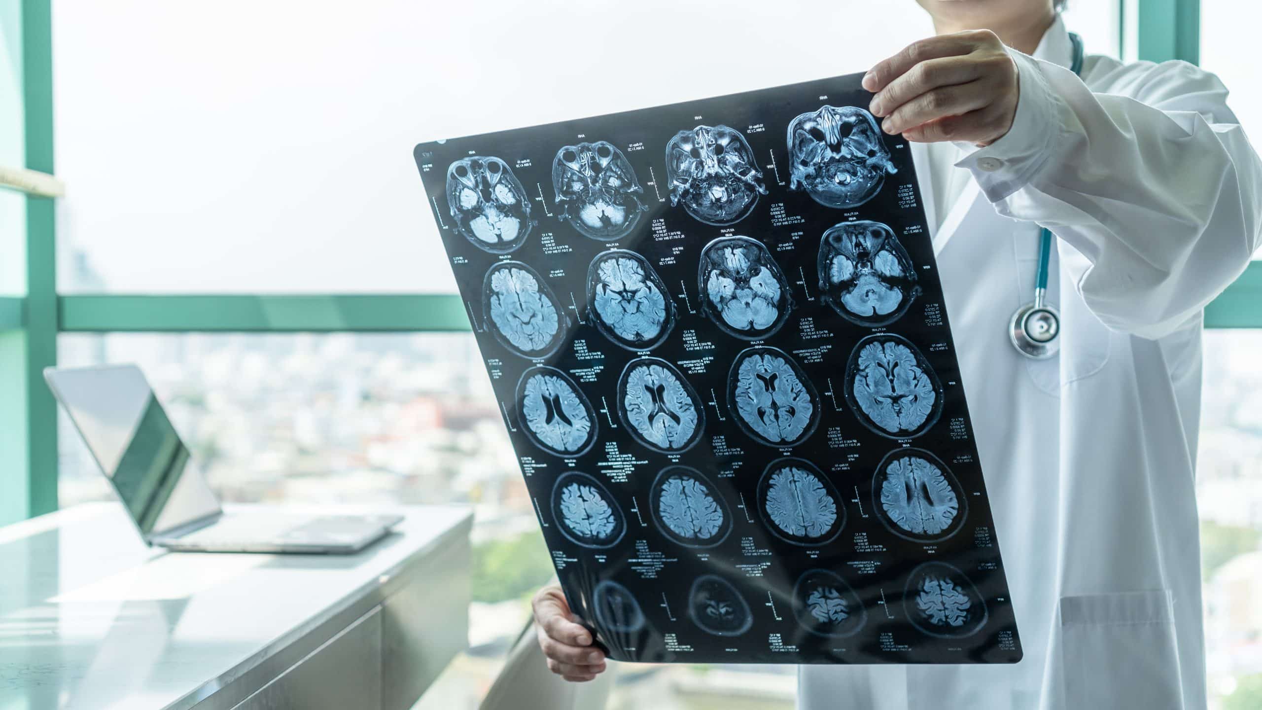 Colorado Springs doctor examining traumatic brain injury scan