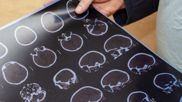 What is a Traumatic Brain Injury?