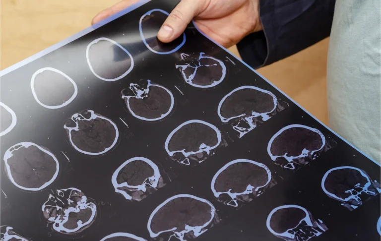 What If I Can’t Afford a Colorado Springs Brain Injury Lawyer?