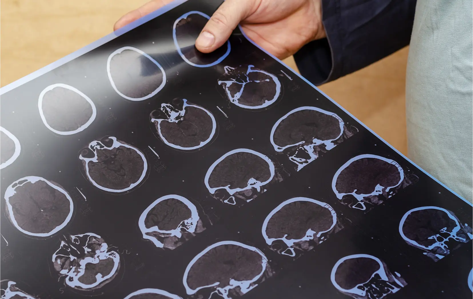 Brain Injury Attorneys in Colorado Springs | Call 719-520-9909